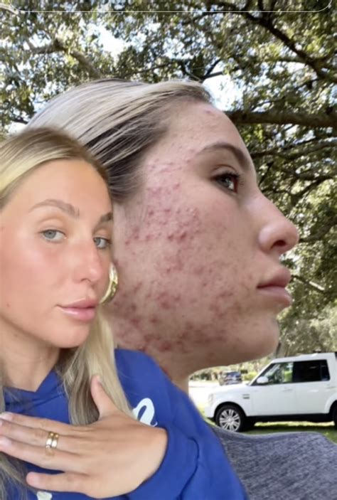 alix earle before accutane|Inside Alix Earles Accutane Journey: The TikTok Star。